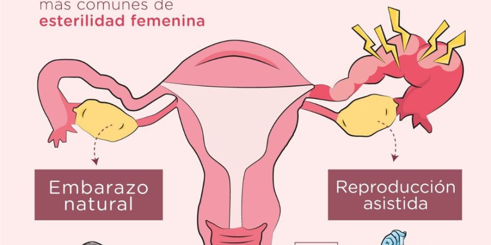 Cómo quedar embarazada con obstrucción de trompas
